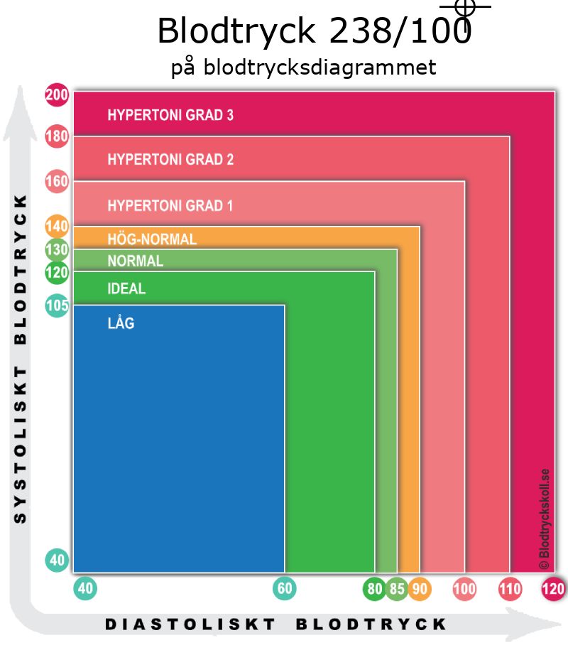 Blodtryck 238 över 100 på blodtrycksdiagram